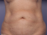 CoolSculpting by Zeltiq to Abdomen