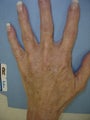 65 yo female with bulging hand veins