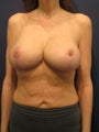 Augmentation mastopexy for significant weight loss