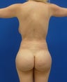 Brazilian Butt Lift