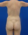 Brazilian Butt Lift