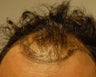 New York City Hair Transplant.  37 Year Old Male.
