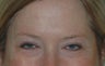 Botox