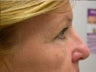 Bilateral Upper Lid Blepharoplasty