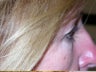 Bilateral Upper Lid Blepharoplasty