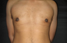 Male Breast Reduction 