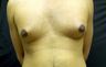 Male Breast Reduction 
