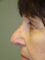 Rhinoplasty
