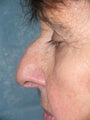Rhinoplasty