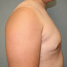 Male Breast Reduction