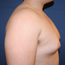 Male Breast Reduction
