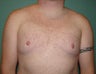 Late results of FTM chest masculinization 