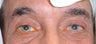 Eyelid Surgery