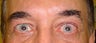 Eyelid Surgery