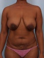 Breast Reduction