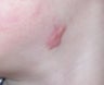 6 year old boy with persistent facial scar