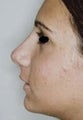 Female patient who underwent nose surgery 