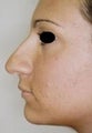 Female patient who underwent nose surgery 