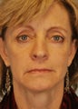 Eyelid Surgery