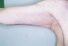 24 Year Old Weight Loss Patient
