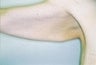 24 Year Old Weight Loss Patient
