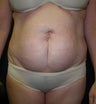 Tummy Tuck