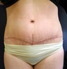 Tummy Tuck