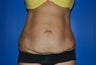 Tummy Tuck