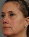 52 year old female with sun damaged skin