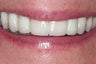 Dental Crown