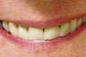 Dental Crown