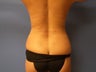 Back / flank / hip liposuction