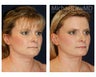 Browlift