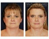 Browlift