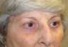 Pretrichial brow lift, Quad-blepharoplasty
