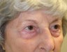 Pretrichial brow lift, Quad-blepharoplasty