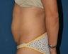 Vaser Liposuction