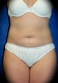 Liposuction