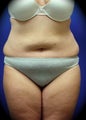 Liposuction