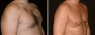 24 year old male, male breast reduction
