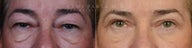 Before and After upper and lower eyelid blepharoplasty