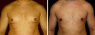 33 year old male, male breast reduction