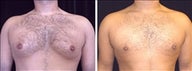 25 year old male, male breast reduction