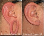 Ear Lobe Surgery