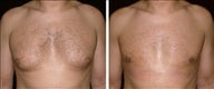 37 year old male, male breast reduction