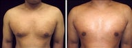 25 year old male, male breast reduction