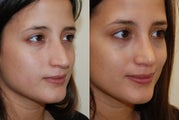 Rhinoplasty Surgery. 1 month post-op.