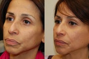Silikon-1000 and Botox.