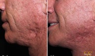 Laser Resurfacing