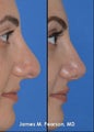 Rhinoplasty / Nasal Surgery